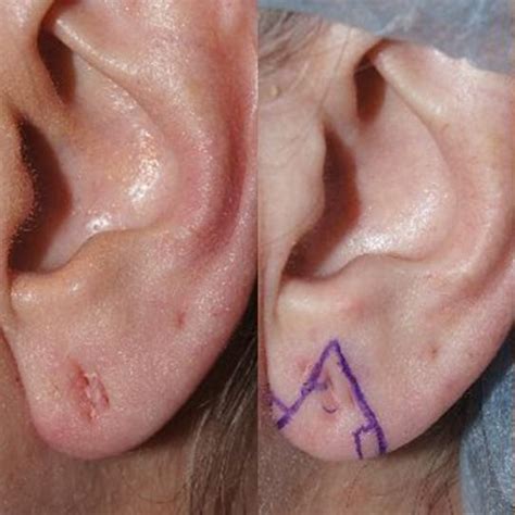 Earlobe Repair photos | Oakland, CA | Patient 13216