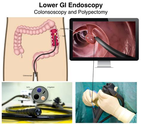 Colonoscopy Procedures by Dr. Mona Dave, Pediatric Gastroenterologist ...