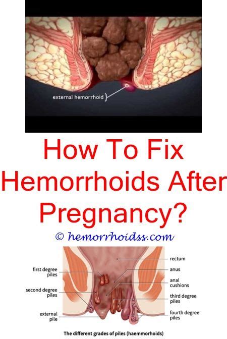 Pin on Hemorrhoids Remedie