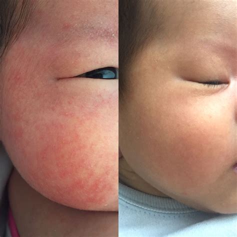 [Get 23+] Early Stage Eczema Rash On Face