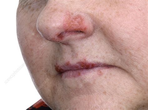 Cold sores on the nose and mouth - Stock Image - C016/6904 - Science Photo Library