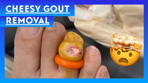 Impressive Cheesy Gout Removal || Cheesy Gout Removal - YouTube