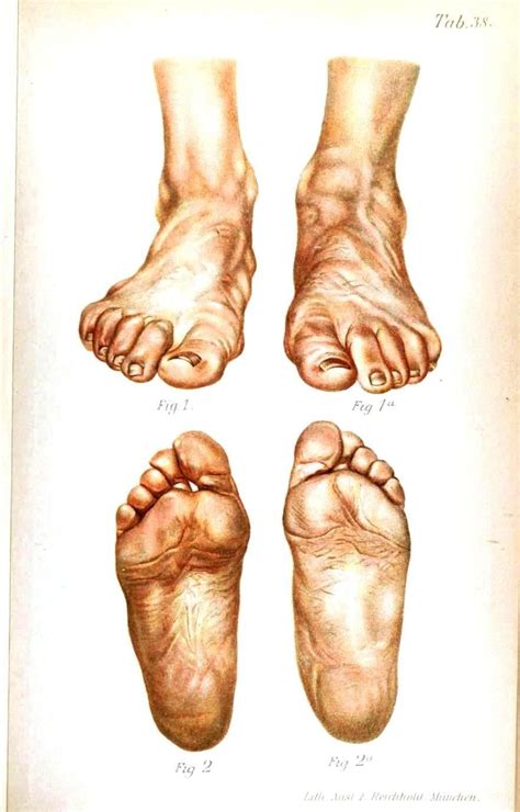 Framed Vintage Medical Print u00 The Human Foot (Picture Pathology ...