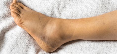 Swollen ankles – causes, symptoms of what diseases, prevention – Healthy Food Near Me