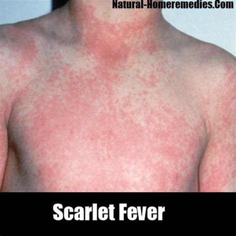 Scarlet Fever Rash On Face