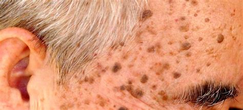 What Causes Seborrheic Keratosis