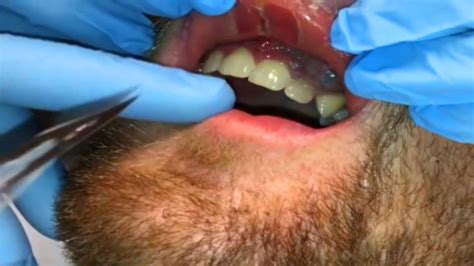 Gum Abscess, Lip Pimp, Facial Cyst Popped - (EXTENDED) - Dental Clinic