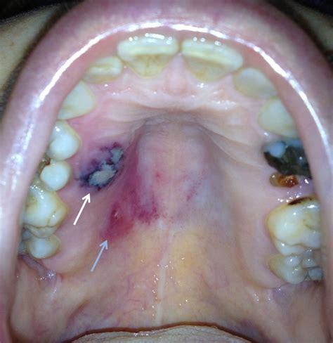 Leukemia Oral Symptoms