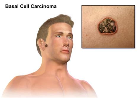 Carcinoma | Symptoms and treatments of this skin cancer