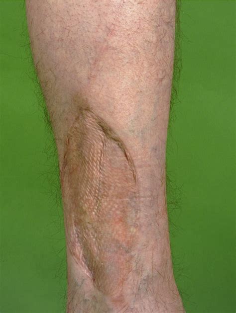 Closure of Osteoseptocutaneous Fibula Free Flap Donor Sites With Local Full-Thickness Skin ...