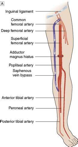 Vascular and endovascular surgery | Medical ultrasound, Ultrasound, Vascular ultrasound