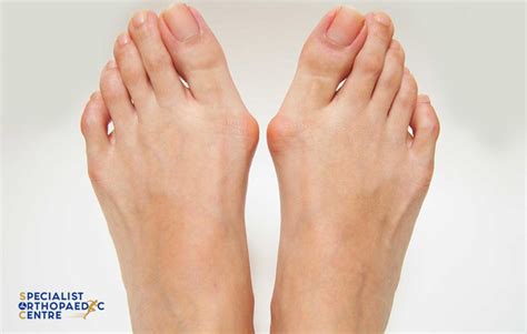 Bunion Surgery Singapore | Bunion & Gout Symptoms | SOC