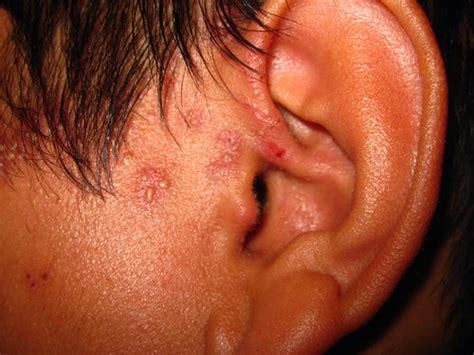 Shingles Lesions (Varicella Zoster, Trigeminal/Mandibular)… | Flickr