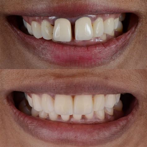 Cosmetic Dentist Photo Gallery | Los Angeles Dentistry Procedures Pics