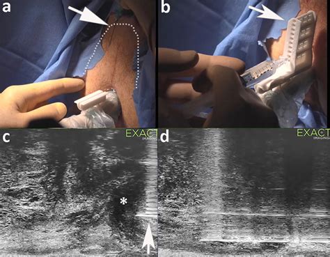 MRI-targeted prostate biopsies guided by micro-ultrasound and a ...