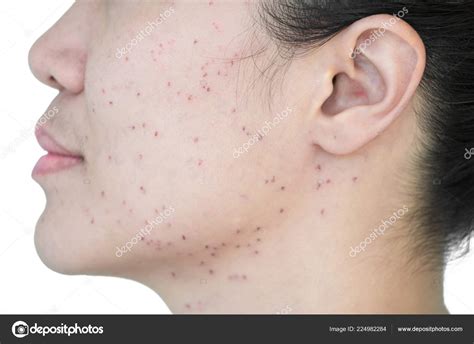 Pictures : skin scabs | Burn Spots Scabs Laser Treatment Acne Skin Freckles Freckles Dark ...
