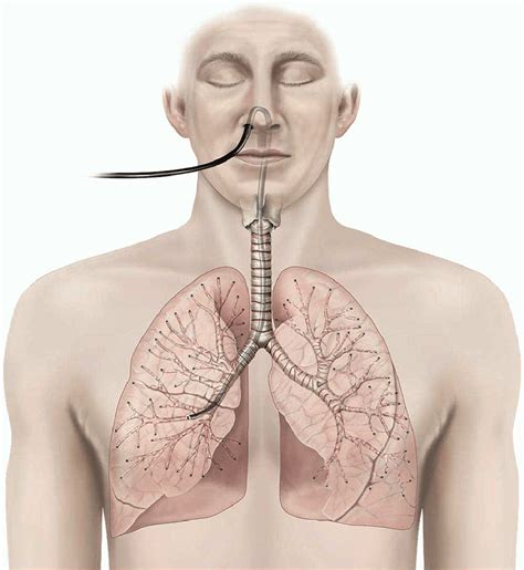 Transbronchial biopsy | healthdirect