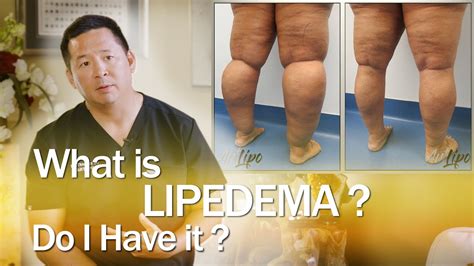 Lipedema Surgery Liposuction | Expert Dr. Thomas Su | ArtLipo - YouTube