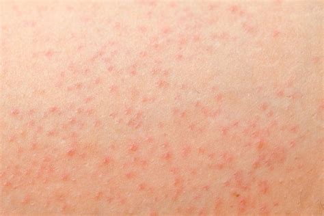 Petechiae: Causes, Symptoms, Treatment & When to Worry - Tua Saúde