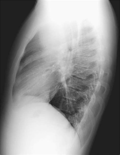 Figure 1 from Lateral chest radiograph a systematic approach. | Semantic Scholar