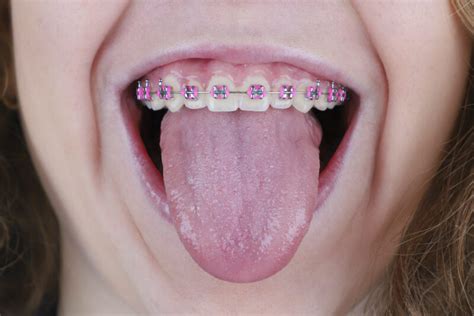 Are Rubber Bands on Braces Important? | Ft Collins CO Orthodontist