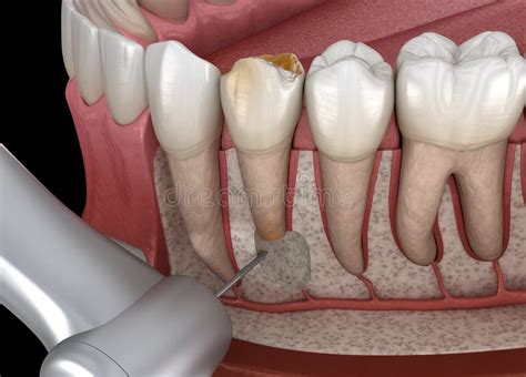 Tooth Cystectomy Surgery - Recovery after Periostitis . Medically ...