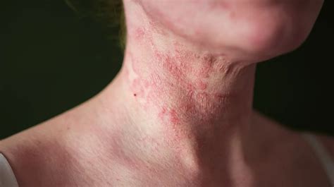 Stress Rash On Neck