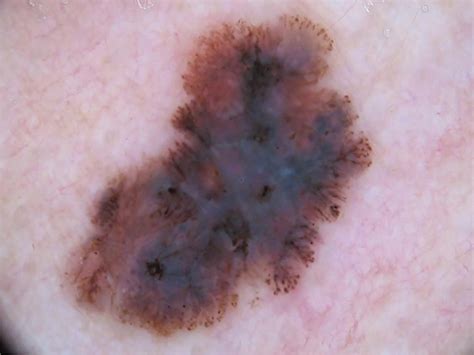 SciELO - Brasil - Dermoscopic evaluation of superficial spreading melanoma , Dermoscopic ...