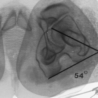 Example of a patient with squinting patella due to excess of tibial... | Download Scientific Diagram