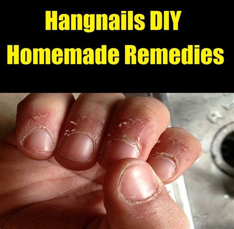 Hangnails DIY Homemade Remedies (With images) | Hangnail, Diy treatment, Healthy skin cream