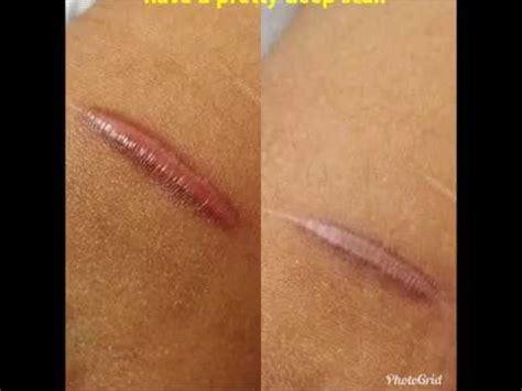 BEGIN TO HEAL HYPERTROPHIC (DEEP) SCARS! - YouTube