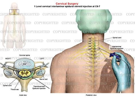 c6-7 interlaminar ESI - Google Search | Cervical, Epidural, Steroids