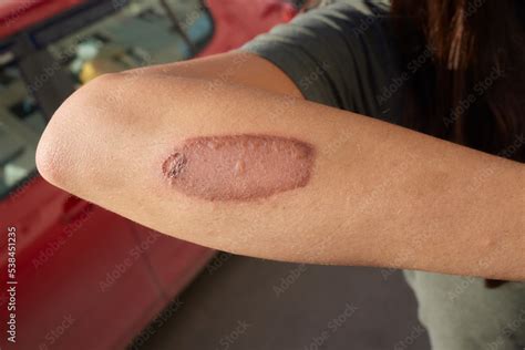 Cut wound on arm and a chemical burn from hydrogen peroxide. Close up of a healing injury of ...