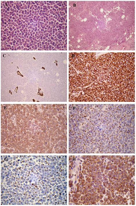 Merkel Cell Carcinoma Pathology / Merkel Cell Carcinoma And Metastatic ...