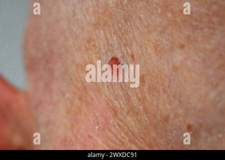 Vorbeugung, Weißer Hautkrebs. Nach der Laser-Behandlung beim Hautarzt bzw der Dermatologie: Die ...