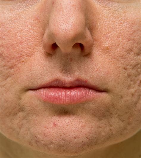 Different Types Of Atrophic Acne Scars And How To Treat Them