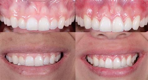 Esthetic Smile Design - Dr. Sam Khoury