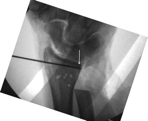 The Sigmoid Notch View for Distal Radius Fractures - Journal of Hand Surgery