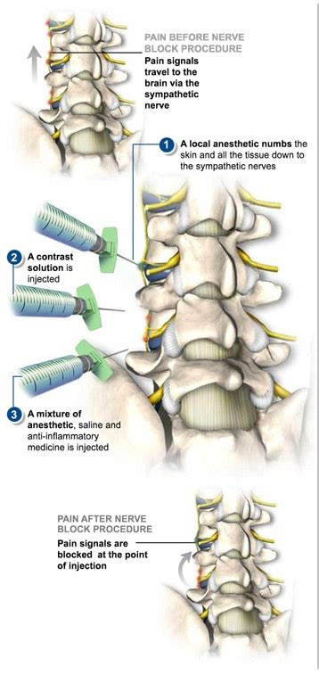 Lumbar Sympathetic Block - The Southeastern Spine Institute