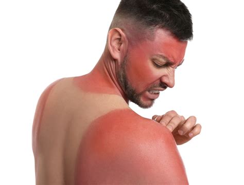 How to Treat Severe Sunburn | Complete Care