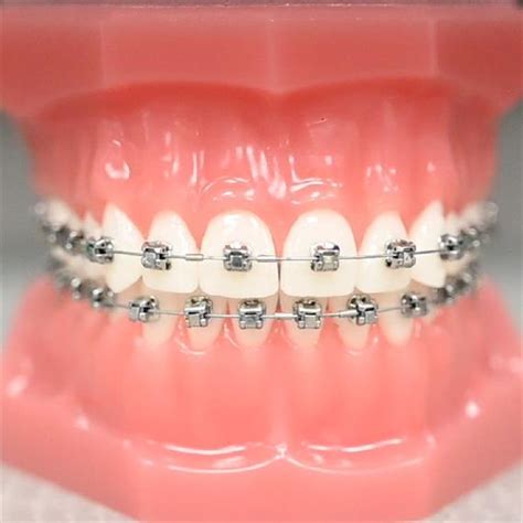 Braces Kenner LA, Lakeside Dental Care