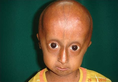 Hutchinson Gilford Progeria Syndrome Body