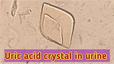 Uric Acid Crystals In Urine