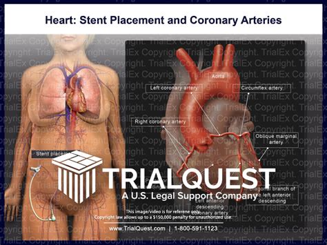 Heart: Stent Placement and Coronary Arteries - TrialExhibits Inc.