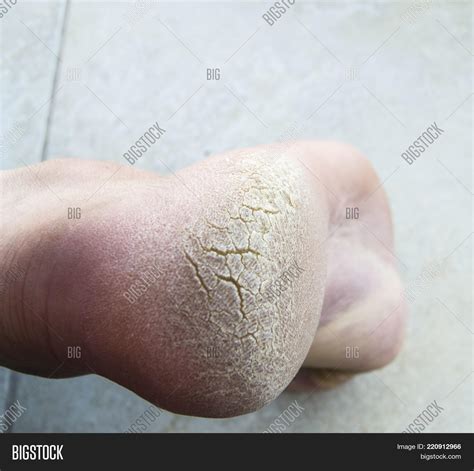 Skin Diseases, Foot Image & Photo (Free Trial) | Bigstock