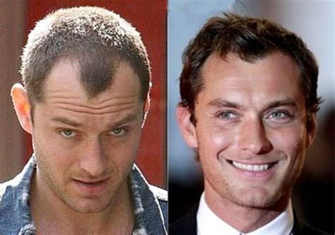 How Much Does Bosley Hair Restoration Cost? [2022 Prices] - Whats the Cost?