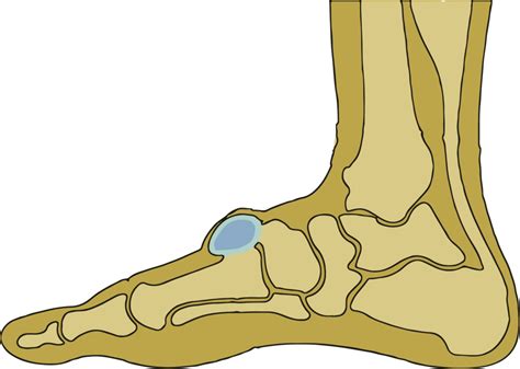 Ganglion Cyst On Bottom Of Foot / Treatment of Ganglion Cysts - Some Data on Results ...