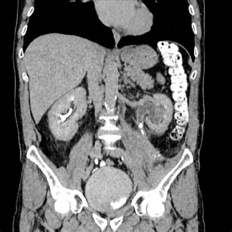 Intraoperative view of an extended Boari flap procedure. Figure 4. A... | Download Scientific ...