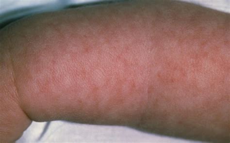 Granny State: Could a mottling rash be meningitis?