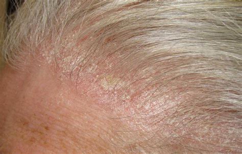 How To Treat A Scabby Scalp – DS Laboratories - Germany